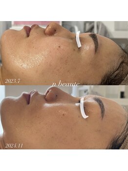 エヌボーテ(n beaute)/HERMOSA/ハーブピーリング