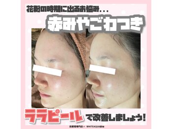 ホワイトアクア 岐阜店(WHITE AQUA)/ララピール/岐阜/水光肌