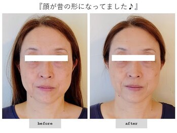 エピファニー(Epiphany)/50代　たるみや首肩こり頭痛が…