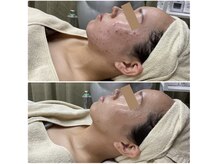 メイス 福井店(MEIS)の雰囲気（【セラピール】before(1回目)after(7回目)）