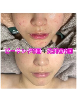 アン(An)/ニキビケア★