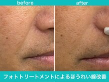 ミスターアンクール 鹿児島(Mr.uncoeur)/フォトトリートメント