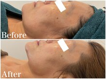 サロンドフェイス(Salon de Faith)/ハーブピーリング