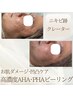 ニキビなどのお肌ダメージ、痕跡や肌の凹凸にお悩みの方◎￥18,000