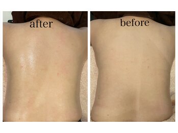 白雲木/背中の黒ずみもハーブピーリング