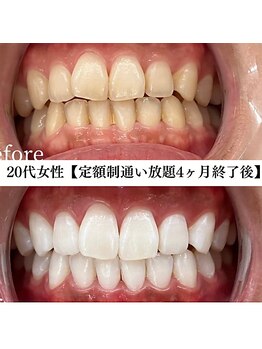 ホワイト 福岡天神店(WHITE)/ホワイトニングビフォーアフター