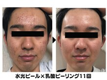 ラディアント たまプラーザ/水光ピール×乳酸ピーリング