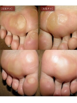 角質フットケアサロン リラックスパーク 大阪難波店(RelaxPark)/足裏の分厚いタコ