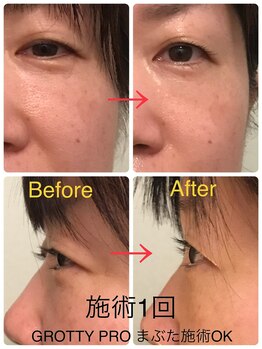 シエルブルー(cielbleu)/グロッティフェイシャル1回