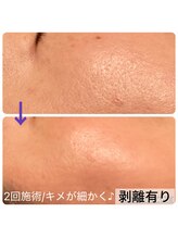 お気軽ビューティエーヴィヒ(Ewig)/当日相談可◆ハーブピーリング◆