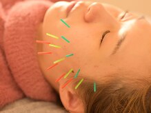 アロエベル(aloe Belle)/美容鍼