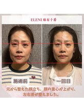 エレーニ 麻布十番(ELENI)/元から整えた顔立ち＃頭蓋骨小顔