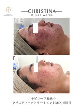 ベルフィーヌボーテ(BELFINE beaute)/CHRISTINAニキビコース経過中