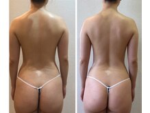 カロン(Kalon)/気になるお背中もスッキリ