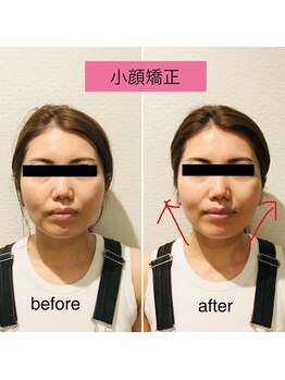チキバンビューティーサロン/小顔矯正