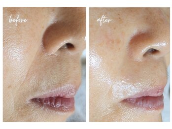 エボルブ 四条烏丸店(EVOLVE)/ほうれい線改善!