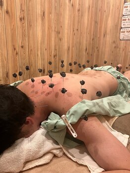 二和まんぷく整骨院鍼灸院/深部の痛みに鍼灸施術