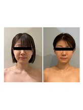 ルナグランデ 心斎橋店(Luna grande.)/極み小顔