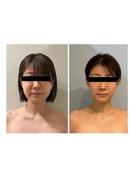 ルナグランデ 心斎橋店(Luna grande.)/極み小顔