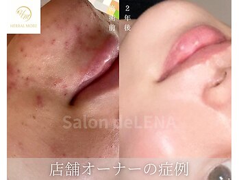 サロンドレナ 名駅店/ハーブピーリング サロンドレナ