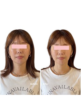 ニコディア(nico-dia)/小顔矯正