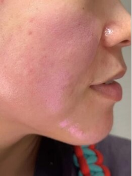 Nua.の写真/【ネイル×本格韓国エステ】最新REDSHOT&レモンボトル導入!理想の美しさを1軒で叶える贅沢サロンです◇