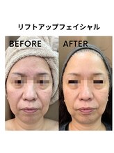 グリン(grin)/ハイブリッドフェイシャル（3）