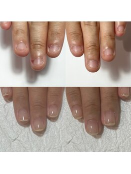 セラキュアネイル(Theracure nail)/深爪でお悩みの方の施術