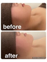 ギンザアール(GINZA R.)/小顔ケア♪