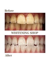 ホワイトニングショップ 岸和田店/お客様のBefore  After
