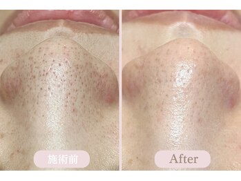 エピル(EPIL)/DEEPクリアスキン毛穴洗浄症例