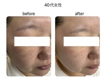 マーレ(Mare)/幹細胞上清上液美容液で若見え肌