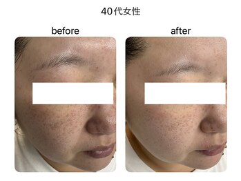 マーレ(Mare)/幹細胞上清上液美容液で若見え肌