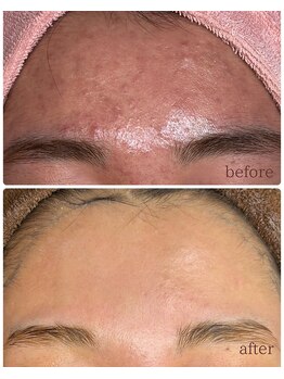 ミハン ボーテ(mihan.beaute)/【ニキビ・赤み】