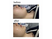 クレセント(crescent)/二重顎撃退！ウルドム管理