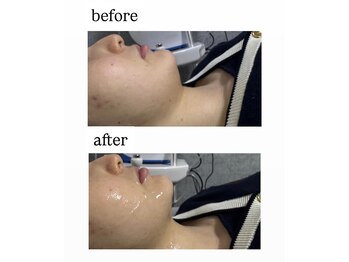 クレセント(crescent)/二重顎撃退！ウルドム管理