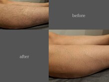 テリー(Terry)/men's脱毛before after &nbsp;5回照射