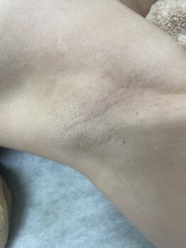 ナノハナ/鹿沼市の全身脱毛のナノハナ