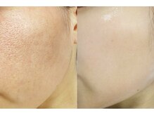 アイラッシュ ミル 御領店(eye lash Miru)/効果即実感！！美肌ピーリング