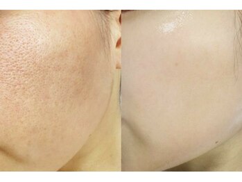 アイラッシュ ミル 御領店(eye lash Miru)/効果即実感!!美肌ピーリング