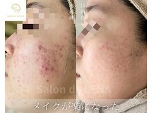 サロンドレナ 名駅店/ハーブピーリング サロンドレナ