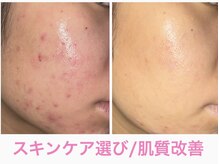 サロンドフェイス(Salon de Faith)の雰囲気（肌質改善は当店で★ホームケアアドバイス+サロンケアで肌革命♪）