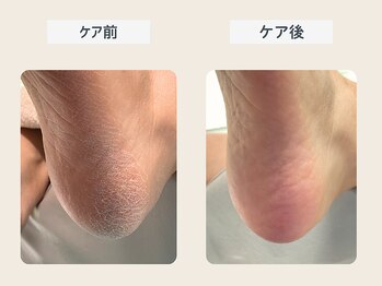 ルポ 伊勢/かかと角質ケア