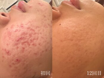 ウォーム(warm)/ニキビケア/肌荒れ/ニキビ肌