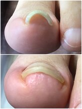 モアクリスタル(More Crystal)/巻き爪補正