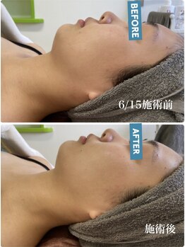 サロンドール(SalonDoll)/陶肌トリートメント