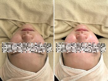 マヴィ 香里園店(MavY.)/水光肌になりましょう