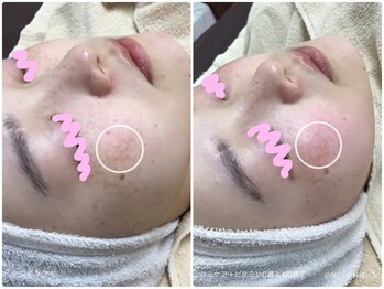 ラウレア(LAULEA)/シミ改善Before/after(3ヶ月)