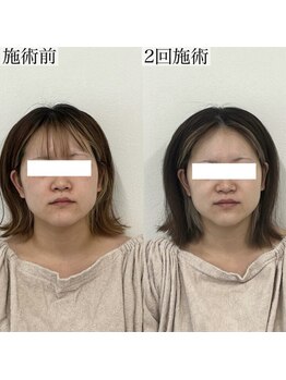 ヴェルシック(Belchic)/2回でこの変化