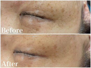 サロンドフェイス(Salon de Faith)/ハーブピーリング